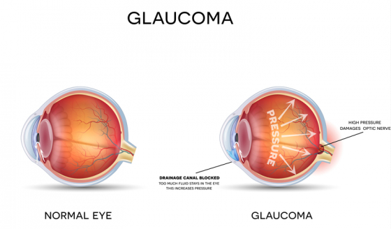 the difference between a healthy eye and an eye with glaucoma